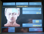 2011 BTL Exilis RF Wrinkle Tightening /w XP 2 & Large Handpieces