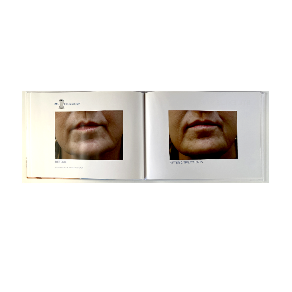BTL EXILIS SYSTEM 715-74 EXBABOOKEN100- Operator´s Manual