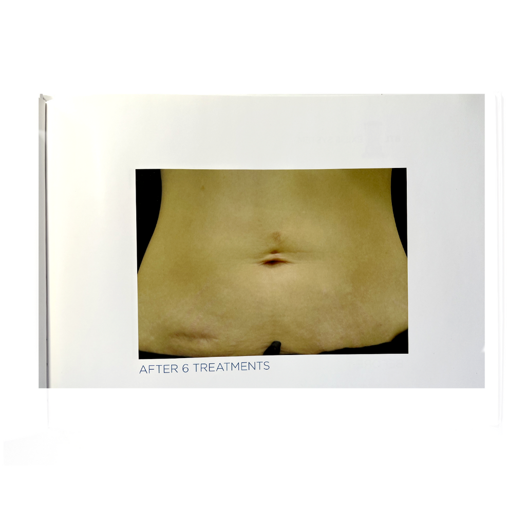 BTL EXILIS SYSTEM 715-74 EXBABOOKEN100- Operator´s Manual