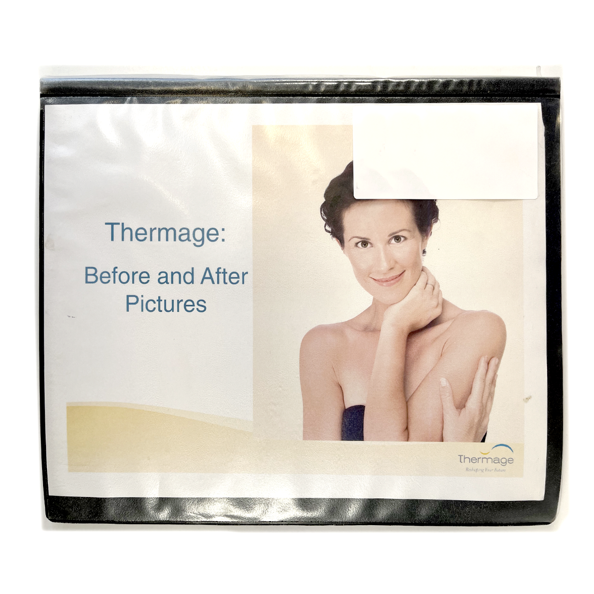 Thermage: Before and After Picture, treatment Guide
