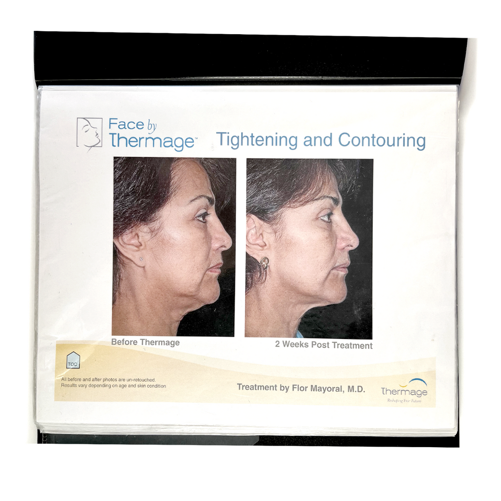 Thermage: Before and After Picture, treatment Guide