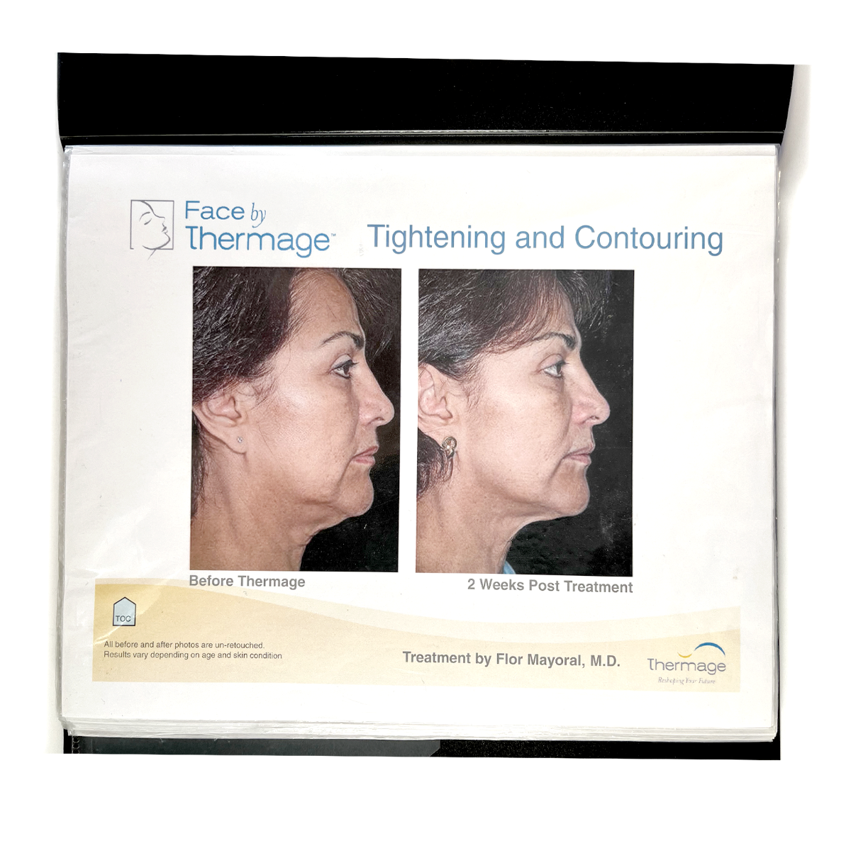 Thermage: Before and After Picture, treatment Guide