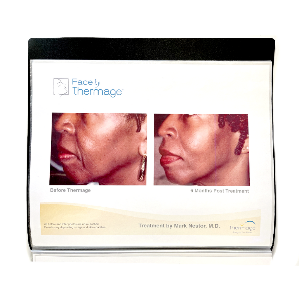 Thermage: Before and After Picture, treatment Guide