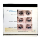 Thermage: Before and After Picture, treatment Guide