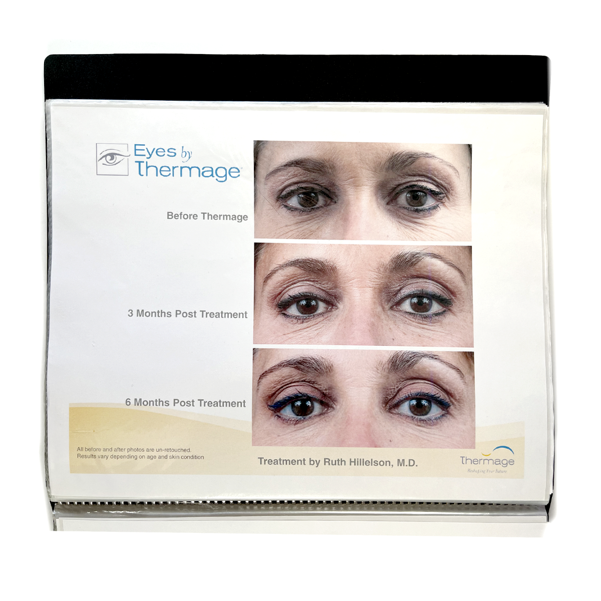 Thermage: Before and After Picture, treatment Guide