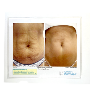Tummy by Thermage Treatment By Dale Isaacson, MD Dermatologic Surgeon