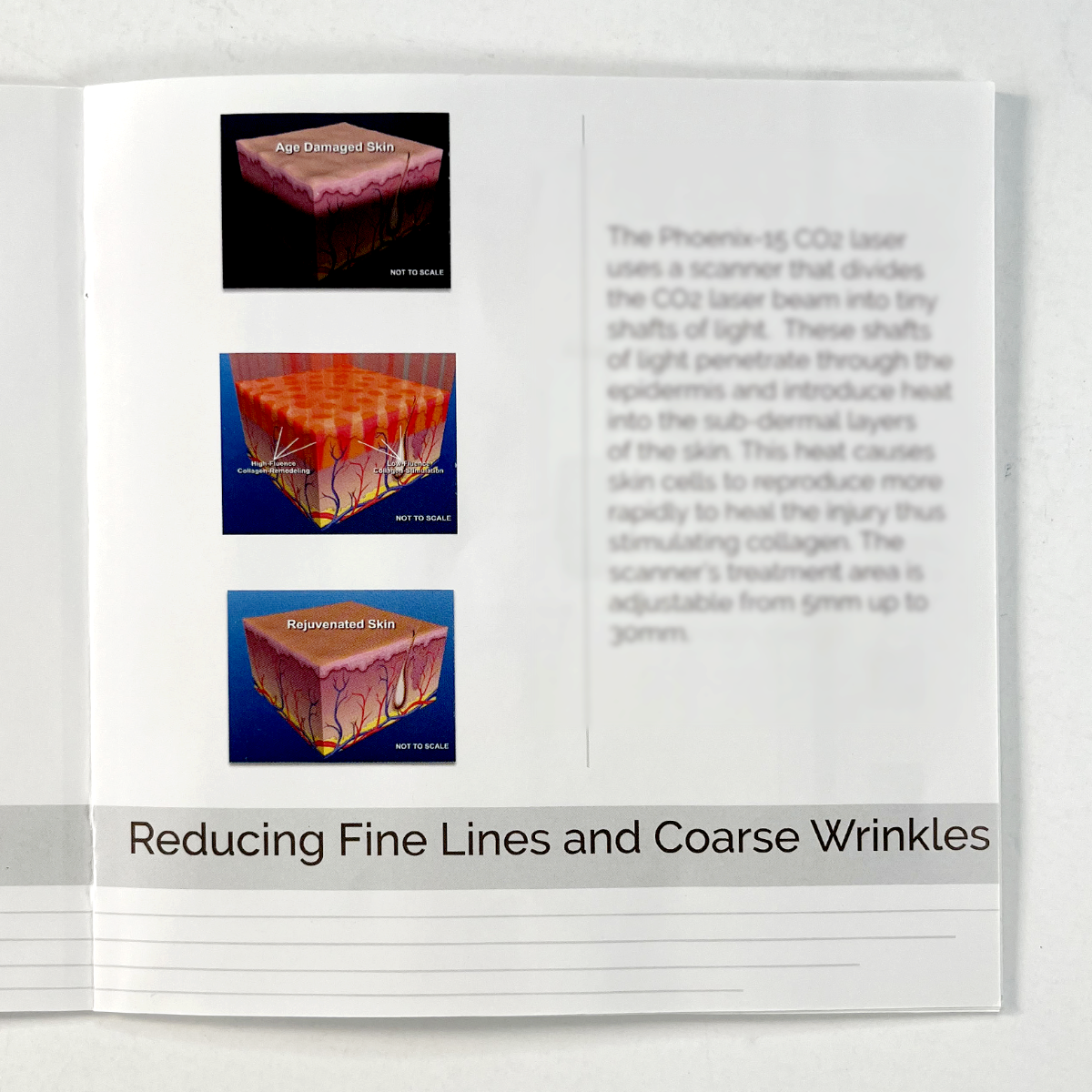 ROHRER AESTHETICS, the phoenix-15 carbon dioxide laser “wrinkle reduction scar reduction pigmentation reduction”