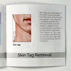 ROHRER AESTHETICS, the phoenix-15 carbon dioxide laser “wrinkle reduction scar reduction pigmentation reduction”