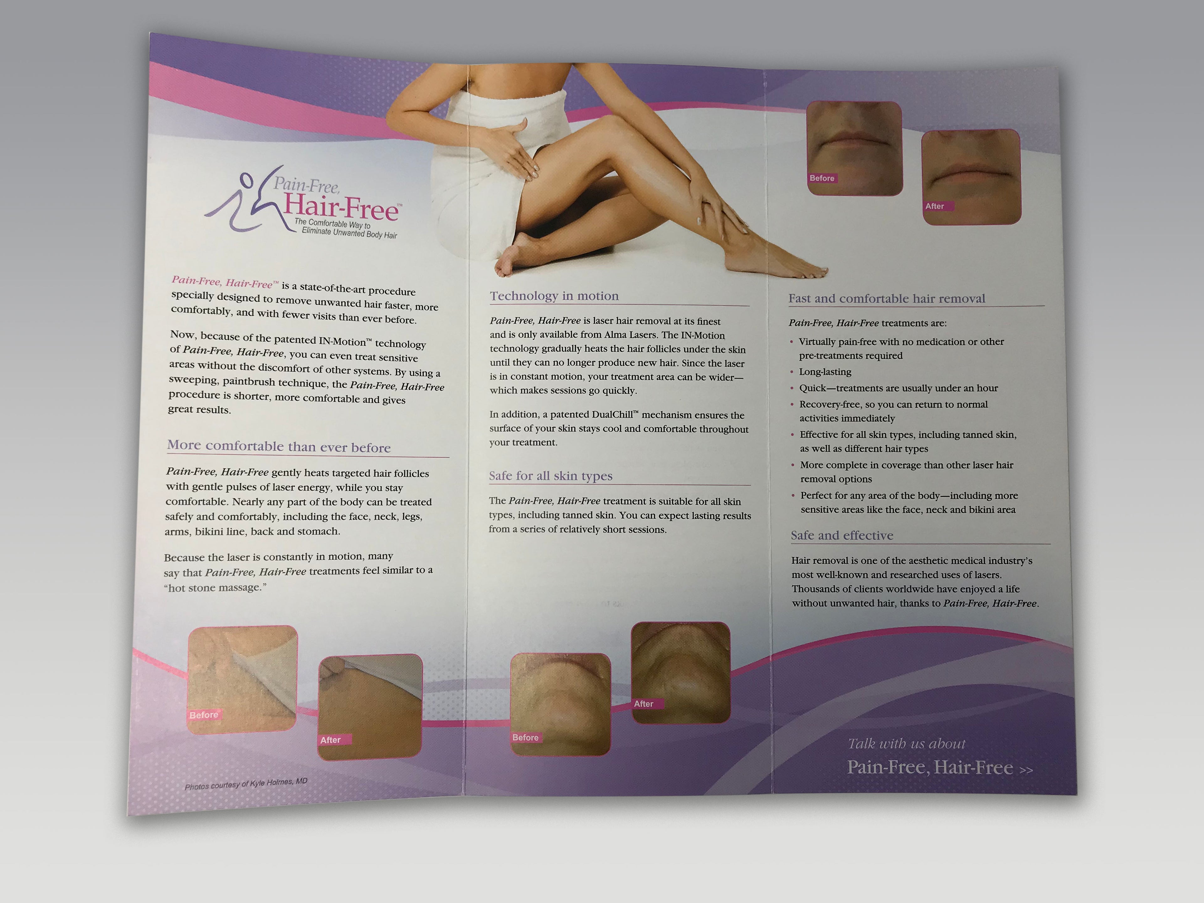 Alma Soprano Laser Pain Free Hair Free Hair Removal Procedure Patient Brochures