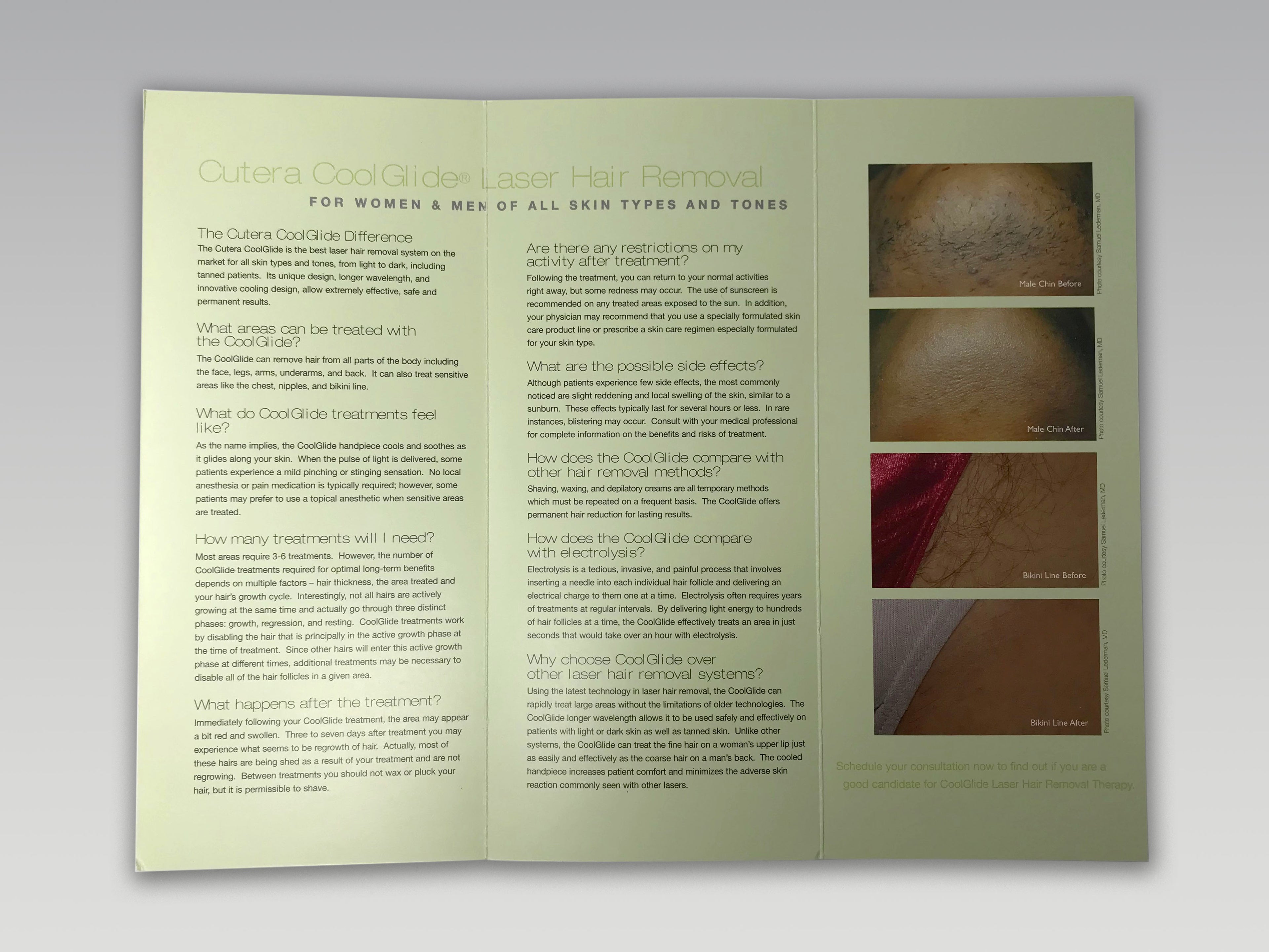 Cutera CoolGlide Laser Cool Glide Nd YAG 1064 Hair Removal Patient Brochures
