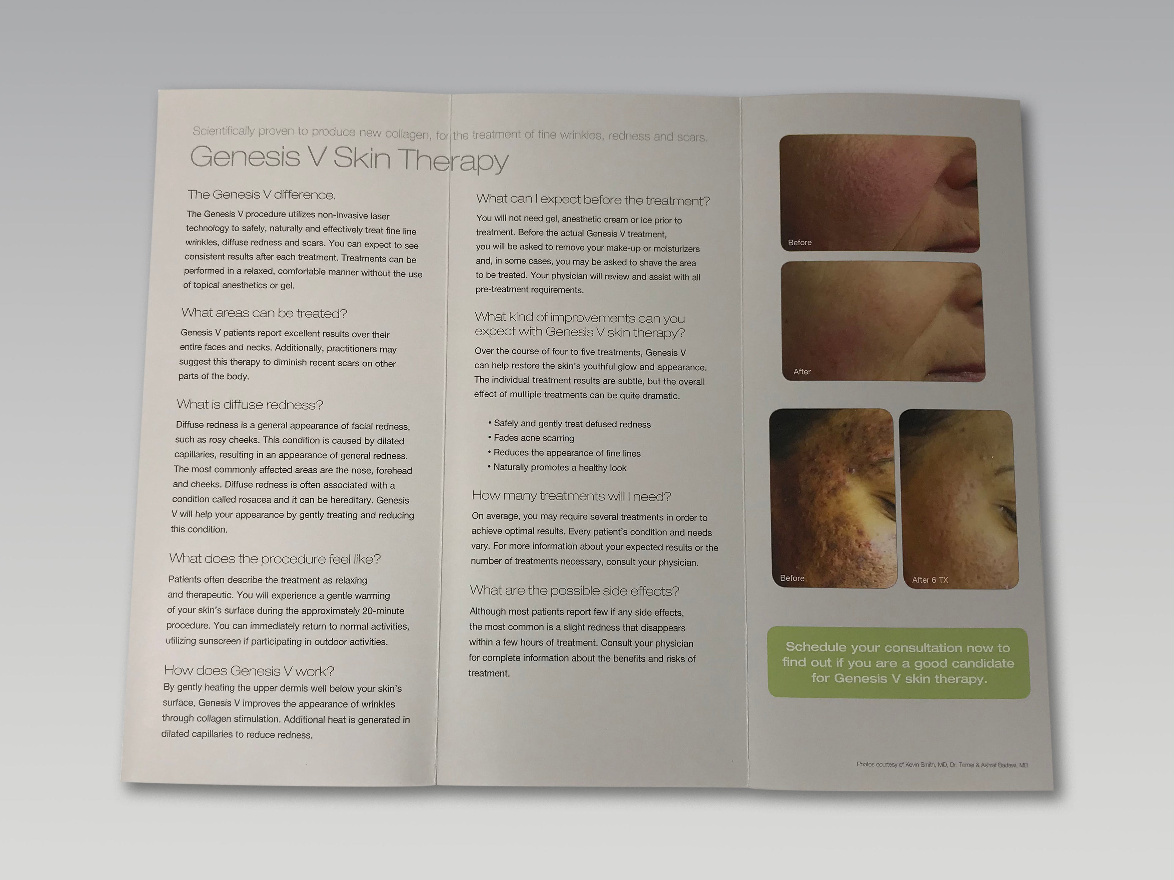 Cutera Excel V Genesis V Laser Redness Wrinkles Scars Treatment Patient Brochure