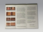 Cutera Excel V Laser Vascular Pigmented Lesion Scar Rosacea Patient Brochure