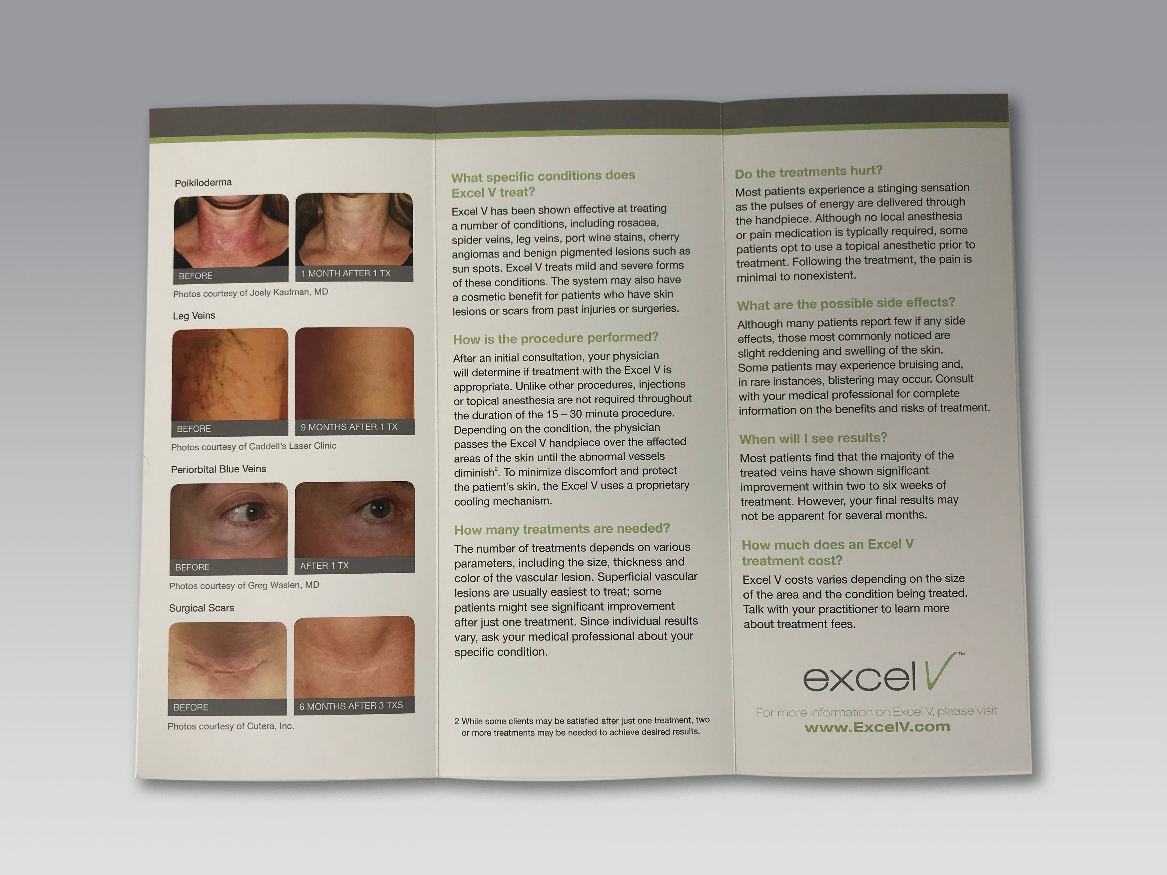 Cutera Excel V Laser Vascular Pigmented Lesion Scar Rosacea Patient Brochure