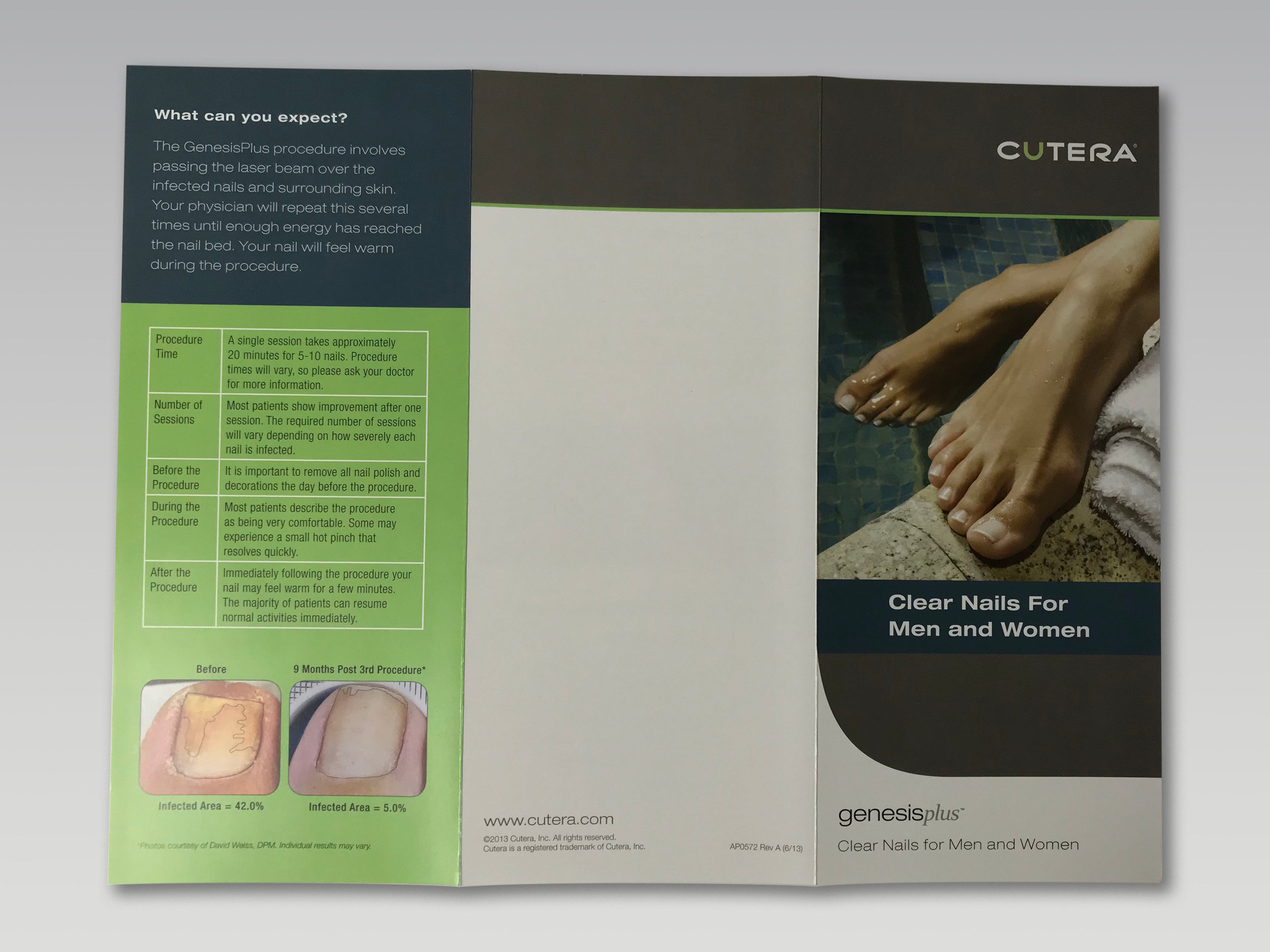 Cutera Genesis Plus Nd YAG GenesisPlus Nail Fungus Treatment Patient Brochures