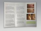Cutera Laser Genesis Fine Wrinkle Redness Scars Skin Therapy Patient Brochure