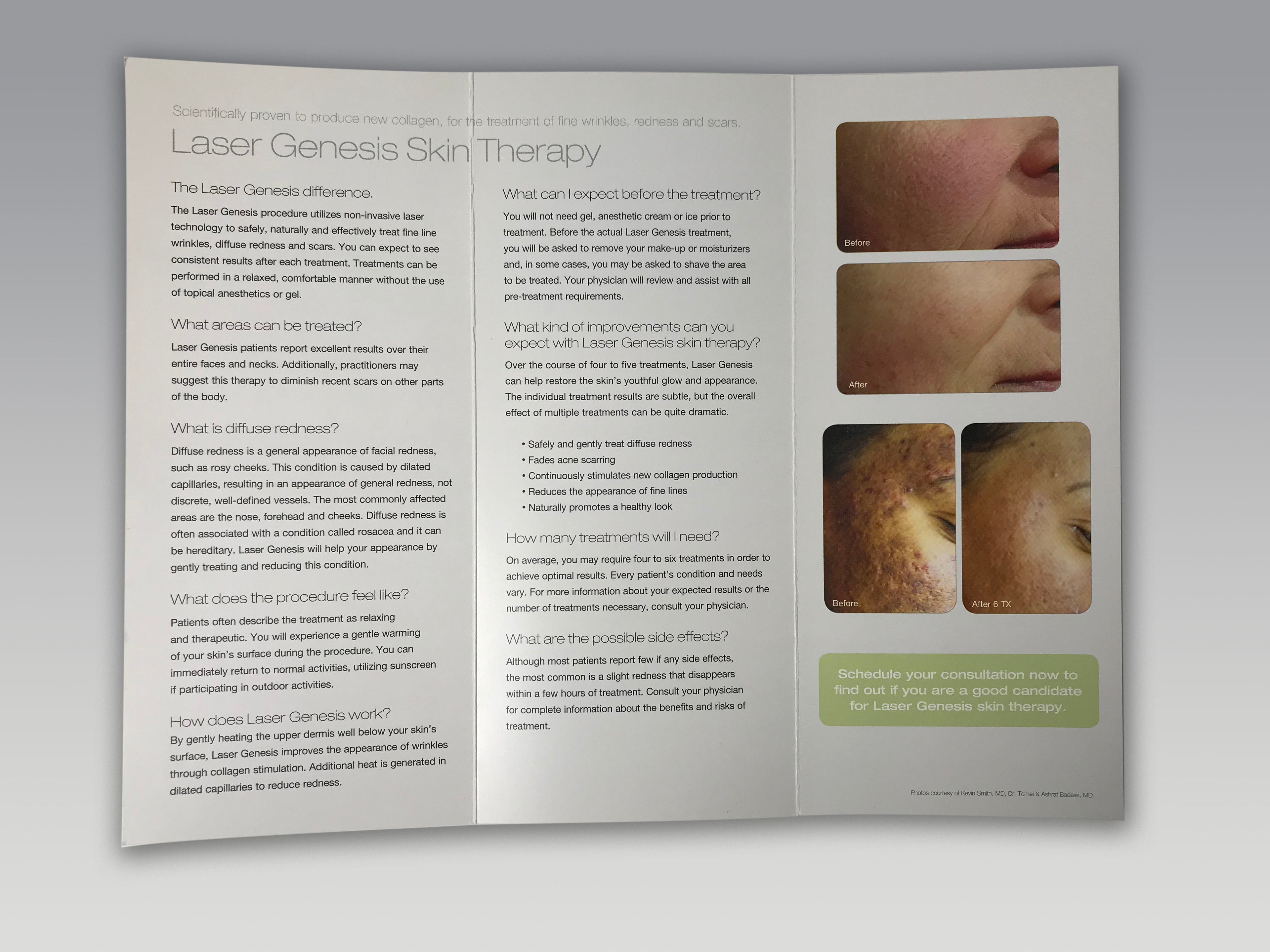 Cutera Laser Genesis Fine Wrinkle Redness Scars Skin Therapy Patient Brochure