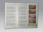 Cutera Lasers Leg Vein Therapy Face and Body Laser Treatment Patient Brochures