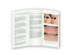 Cutera LimeLight IPL Facial Skin Rejuvenation Pigmentation Vein Brochures 25/pck