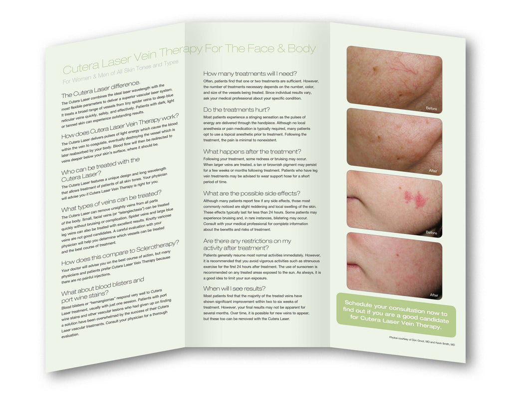 Cutera XEO Laser Vascular Vein Removal Telangiectasia Patient Brochures 25 Pack