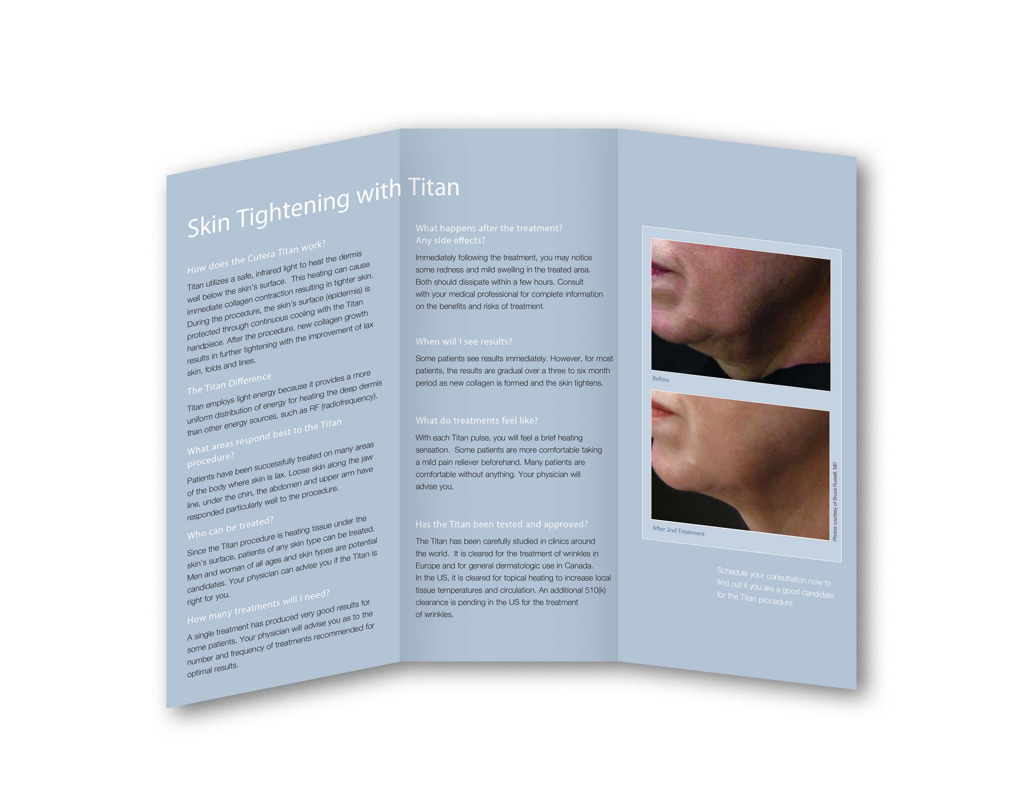 Cutera XEO Titan IPL Skin Tightening Wrinkle Reduction Patient Brochures 25 Pack