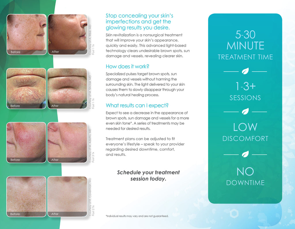 CynoSure Elite Laser Skin Revitalization Marketing Tri Fold Brochures Pamphlets