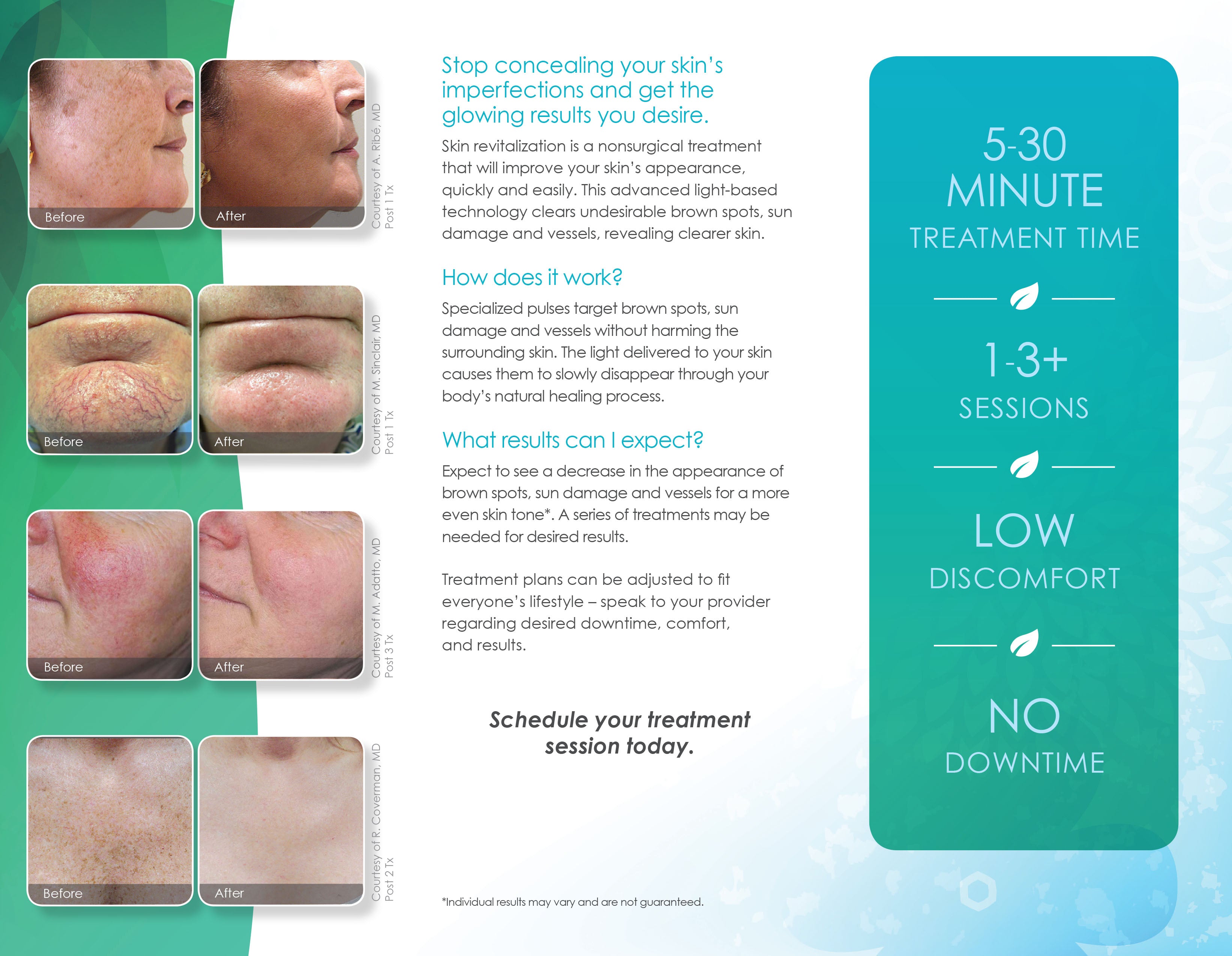 CynoSure Elite Laser Skin Revitalization Marketing Tri Fold Brochures Pamphlets