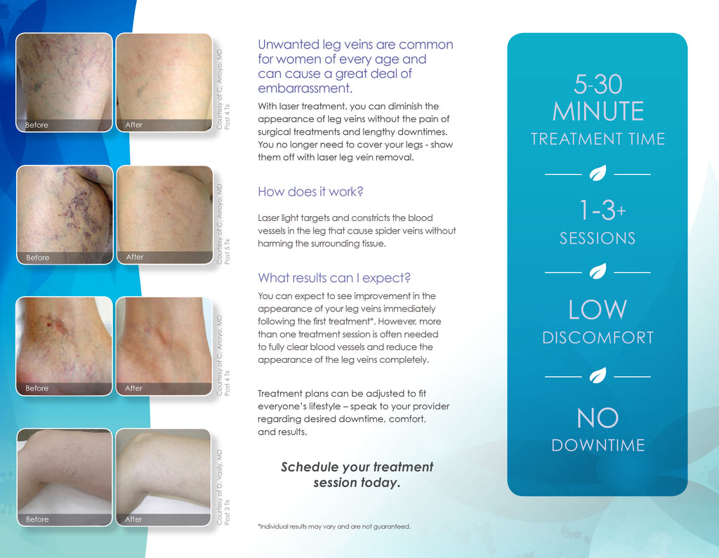 Cynosure Elite Laser Leg Vein Removal Patient Marketing Brochure Pamphlet 100pc