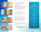 Cynosure Elite Laser Leg Vein Removal Patient Marketing Brochure Pamphlet 100pc