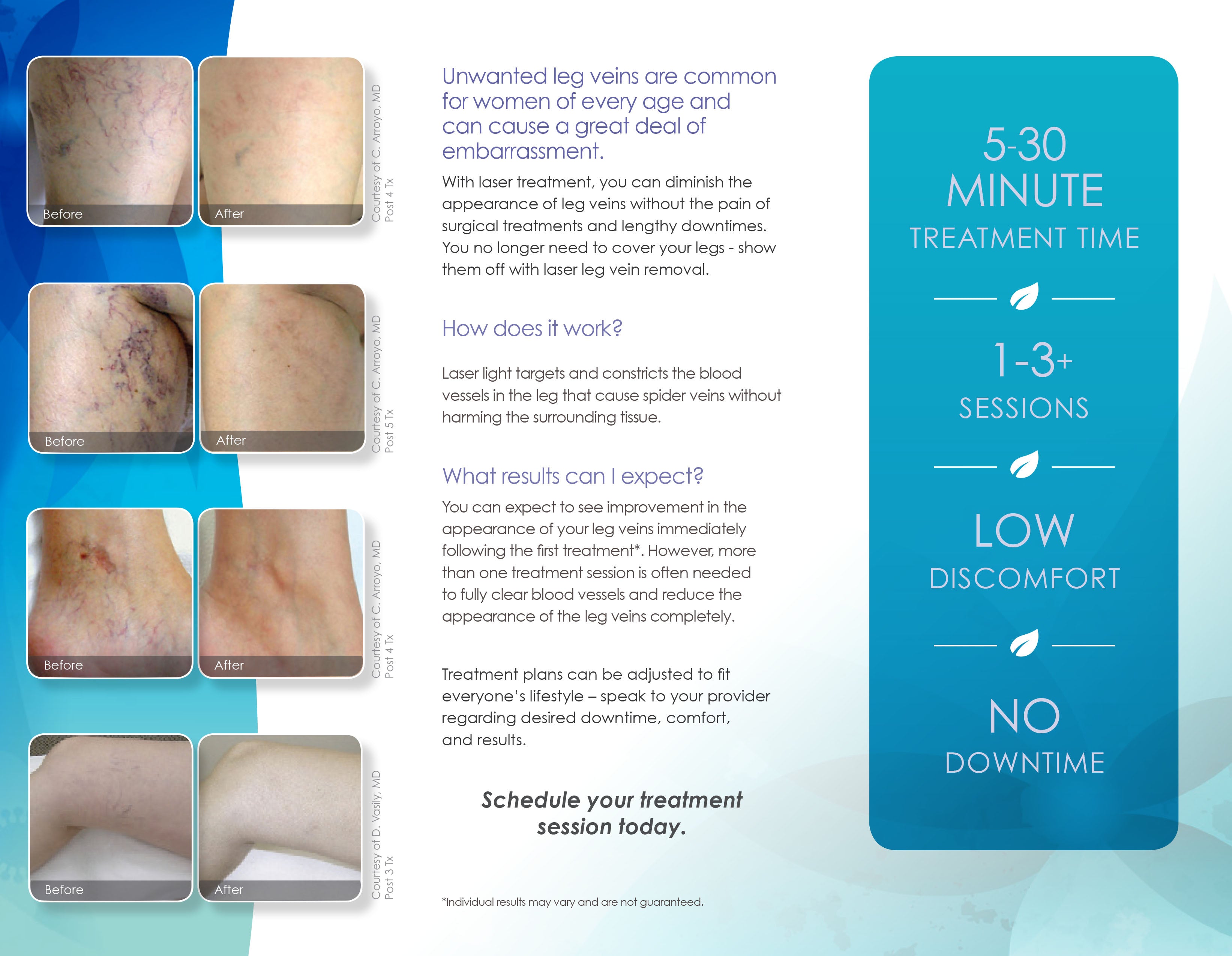 Cynosure Elite Laser Leg Vein Removal Patient Marketing Brochure Pamphlet 100pc