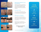 Cynosure Elite Laser Skin Renewal Patient Marketing Brochure Pamphlet 100 Pack