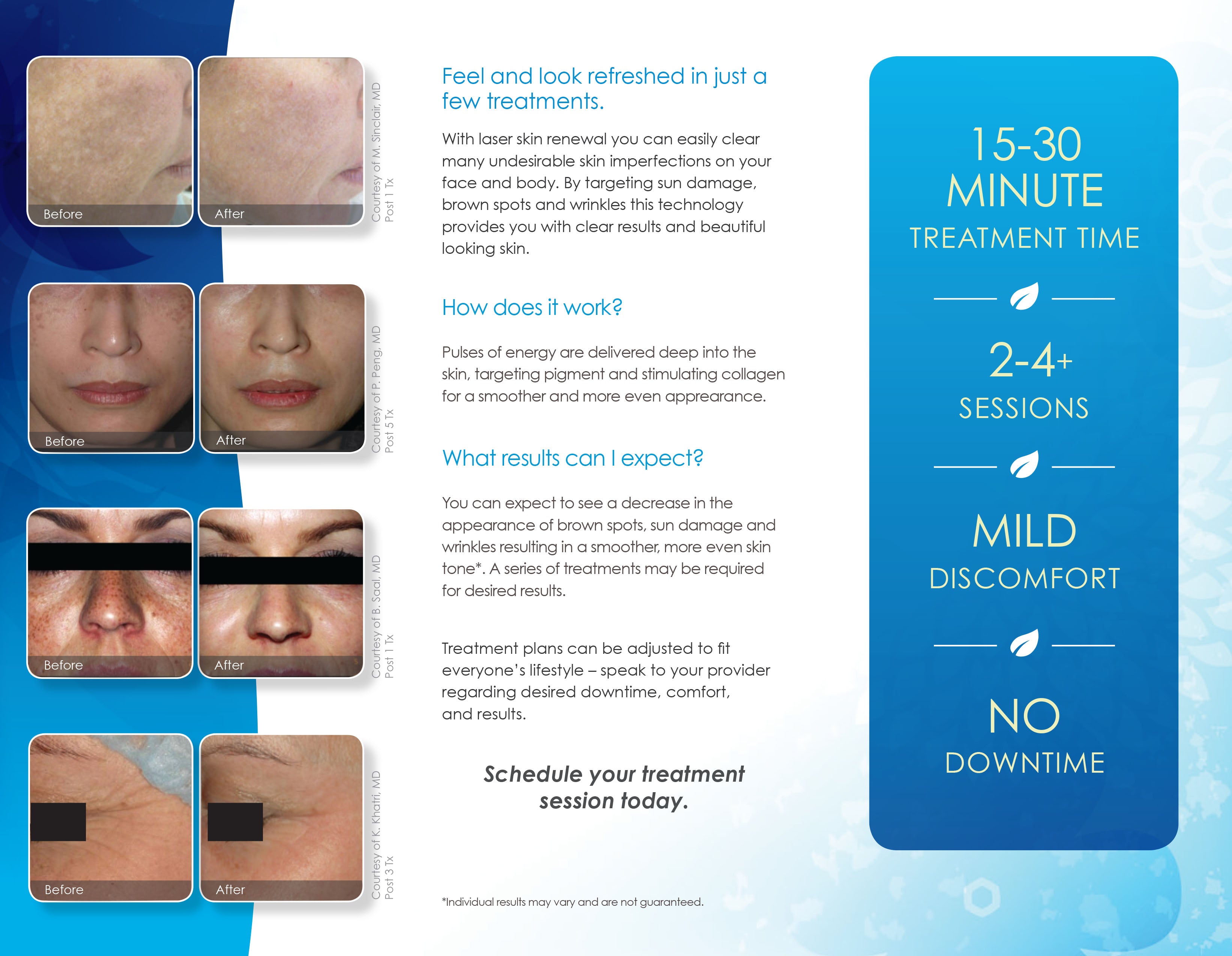 Cynosure Elite Laser Skin Renewal Patient Marketing Brochure Pamphlet 100 Pack