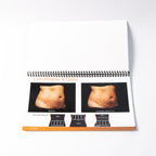 Cynosure SculpSure - Before & After Photos 25 minuet Body Contouring (10 Pages)