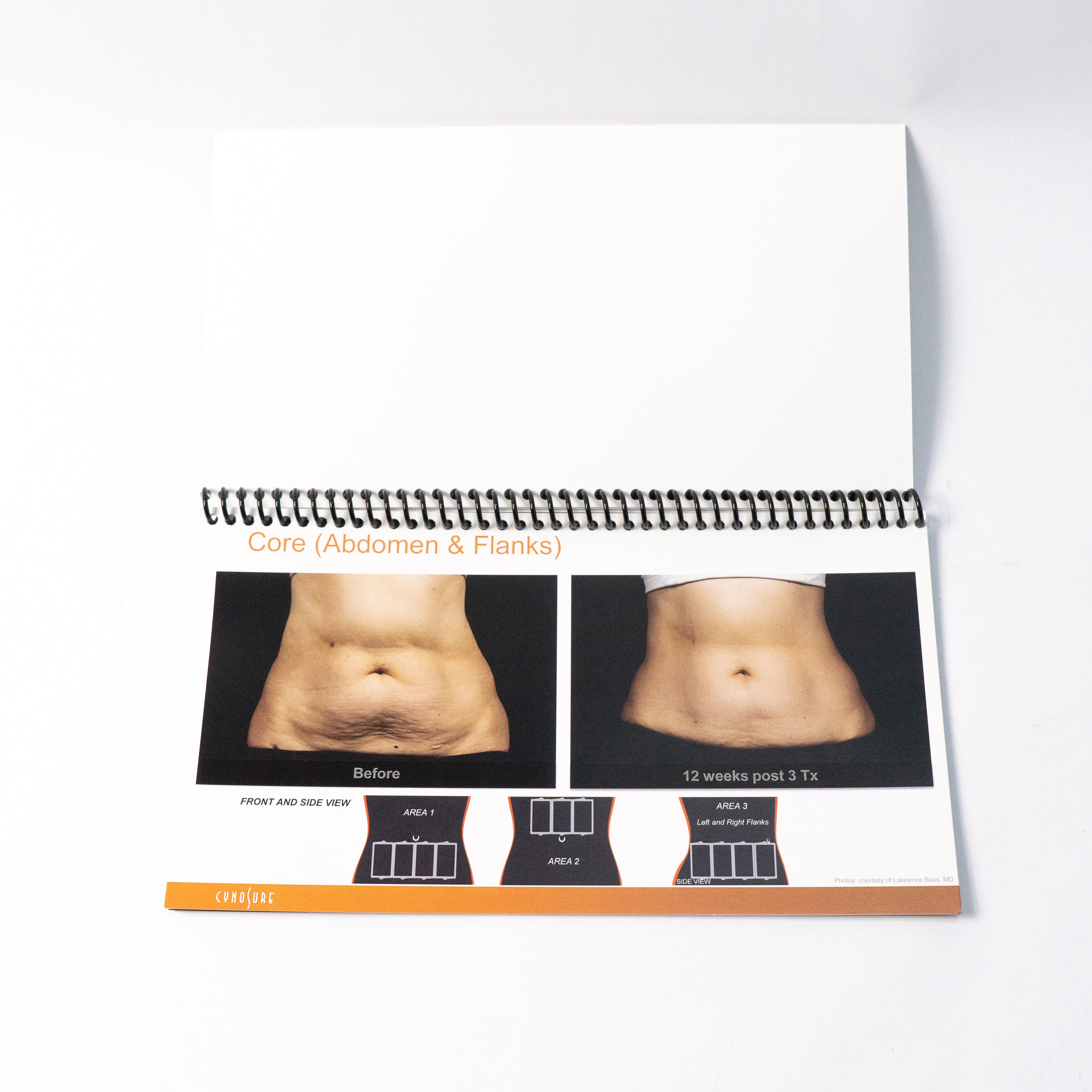 Cynosure SculpSure - Before & After Photos 25 minuet Body Contouring (10 Pages)
