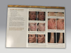 Fraxel 1927 Fractional Skin Resurfacing Laser Pigment Aging Patient Brochures