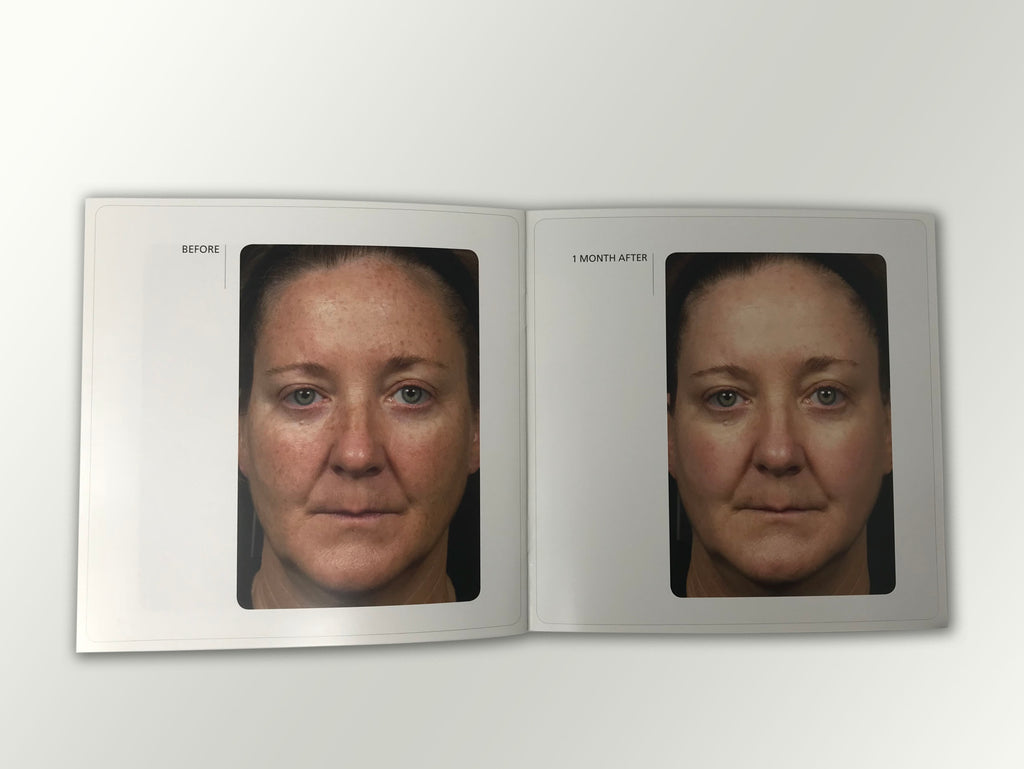 Fraxel Dual 1550 1927 Patient Diary Before & After Progress B&A Brochure Booklet