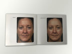 Fraxel Dual 1550 1927 Patient Diary Before & After Progress B&A Brochure Booklet