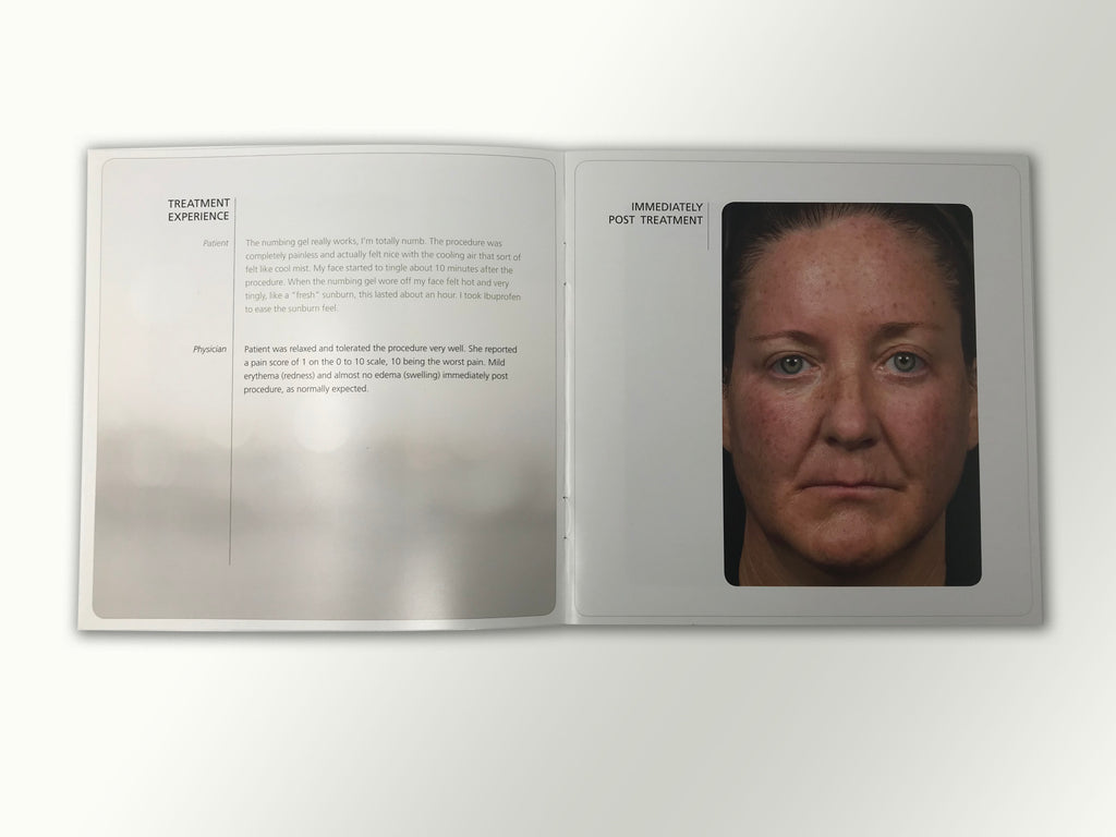 Fraxel Dual 1550 1927 Patient Diary Before & After Progress B&A Brochure Booklet