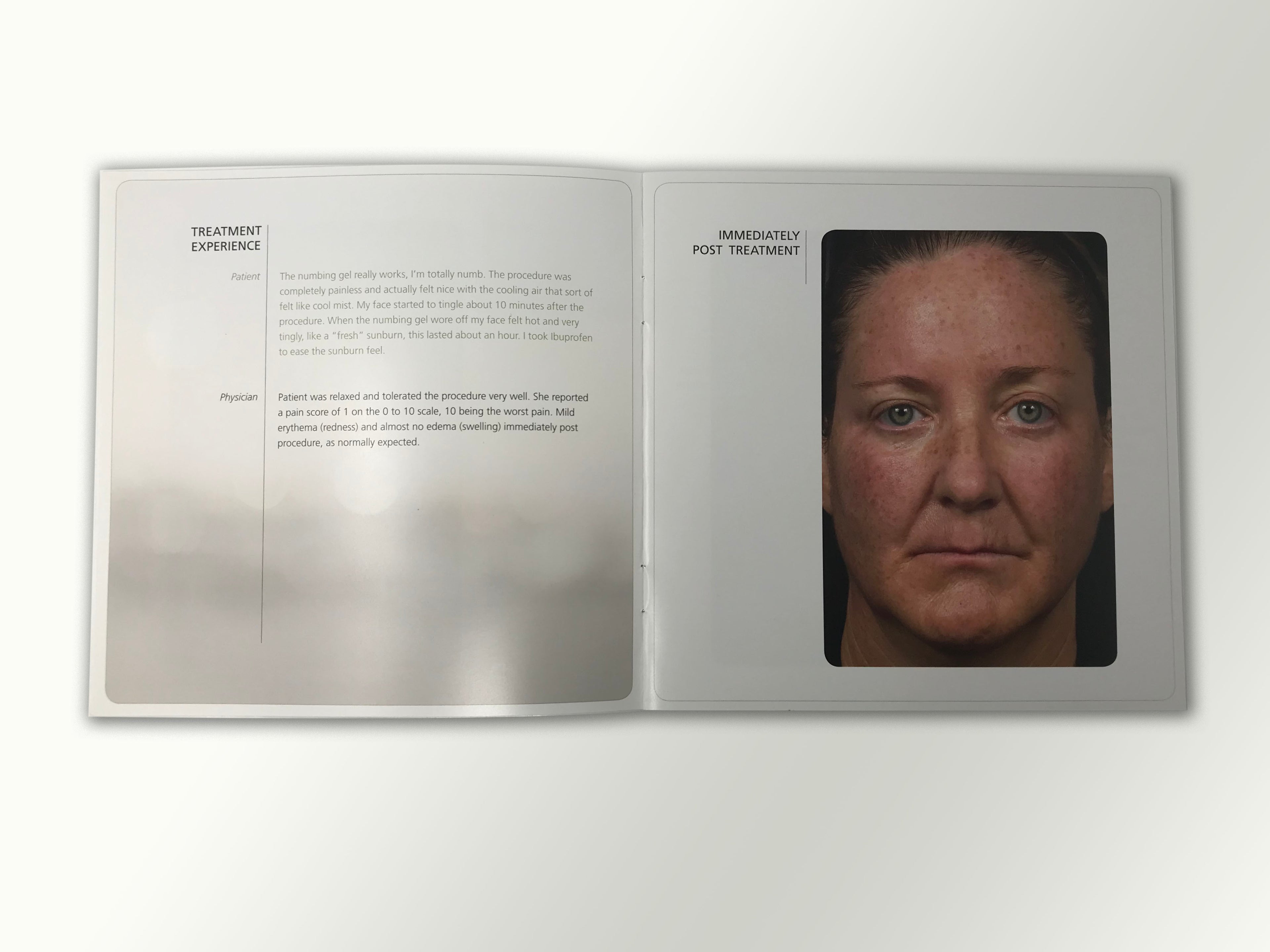 Fraxel Dual 1550 1927 Patient Diary Before & After Progress B&A Brochure Booklet