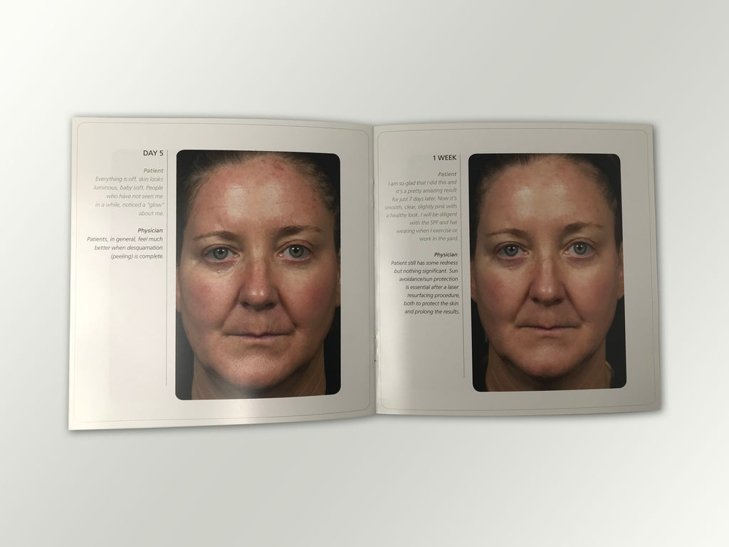 Fraxel Dual 1550 1927 Patient Diary Before & After Progress B&A Brochure Booklet