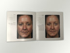 Fraxel Dual 1550 1927 Patient Diary Before & After Progress B&A Brochure Booklet