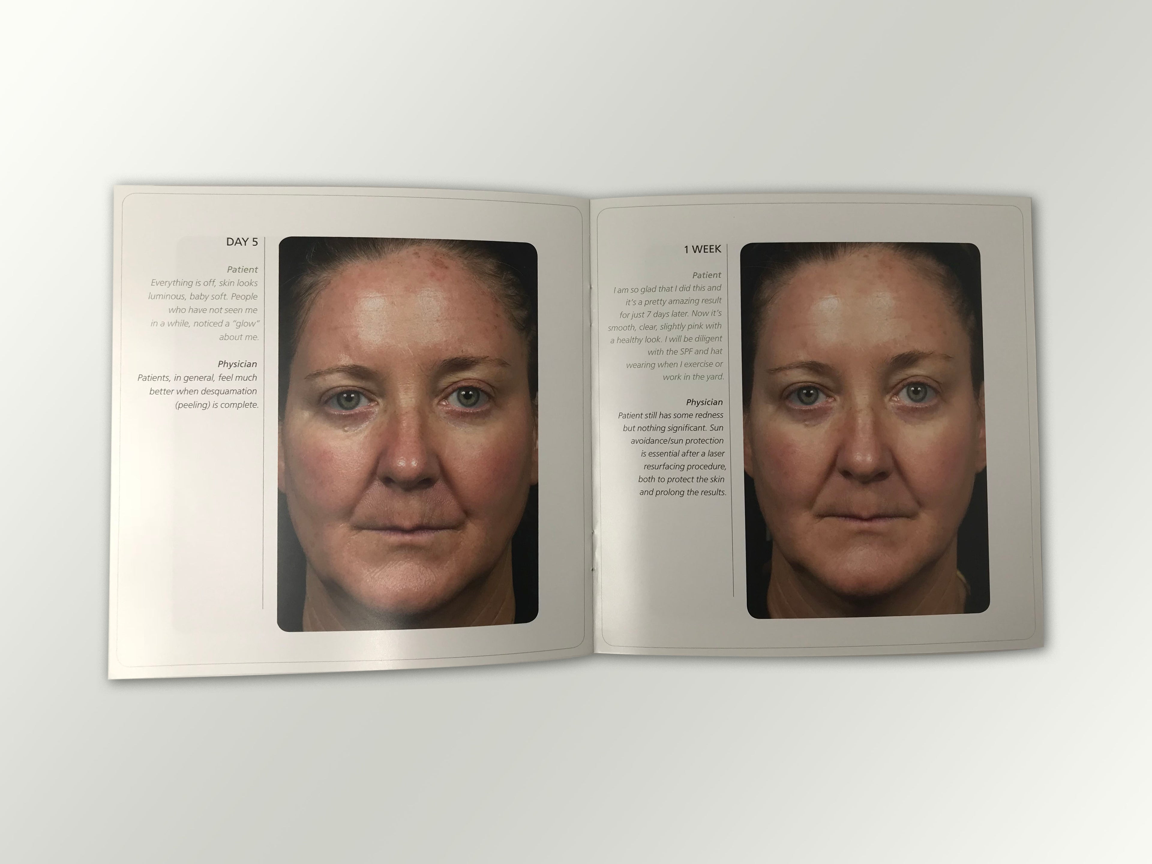Fraxel Dual 1550 1927 Patient Diary Before & After Progress B&A Brochure Booklet