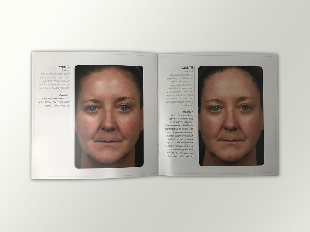 Fraxel Dual 1550 1927 Patient Diary Before & After Progress B&A Brochure Booklet