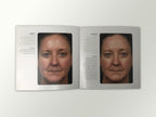 Fraxel Dual 1550 1927 Patient Diary Before & After Progress B&A Brochure Booklet