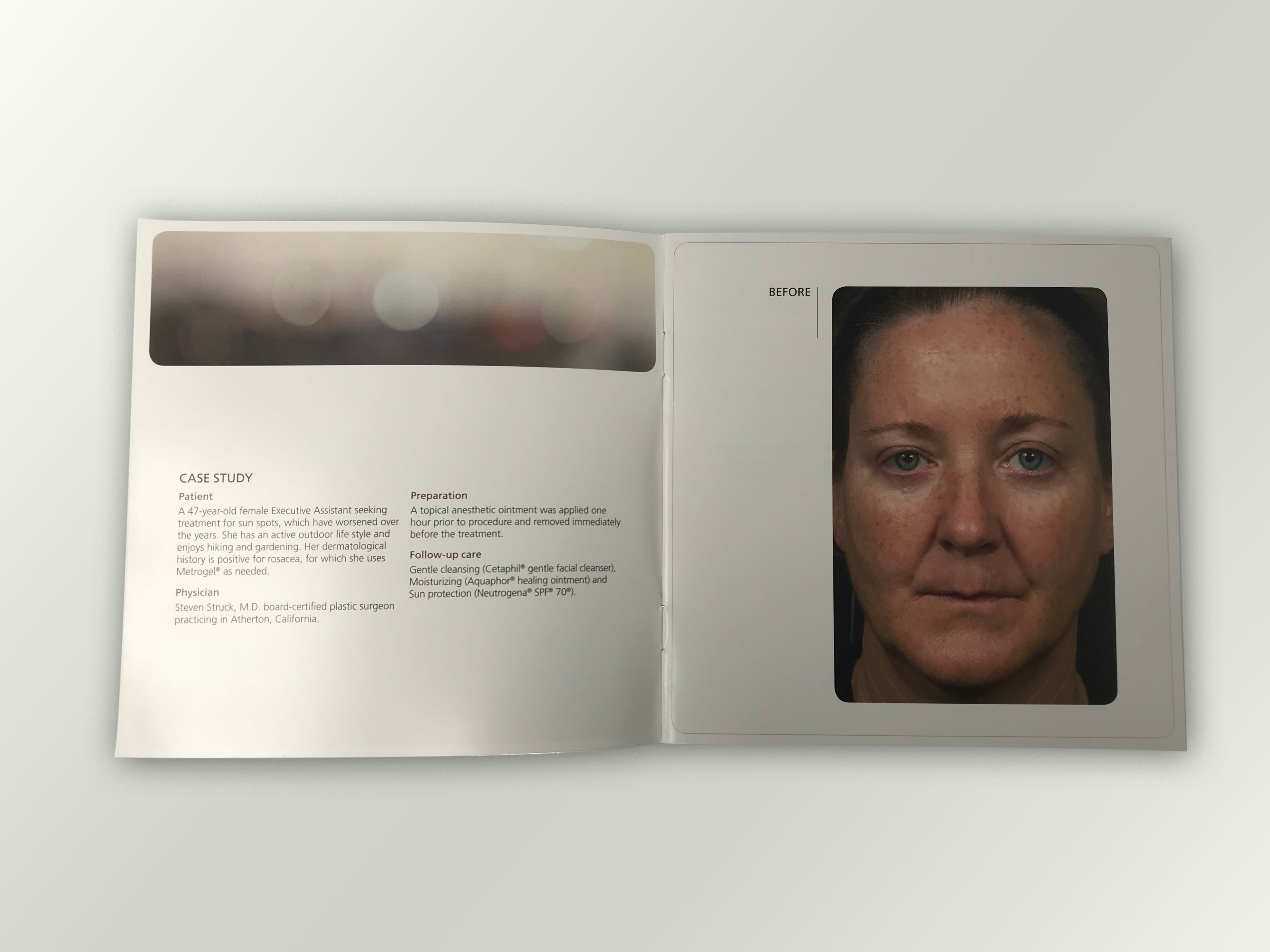Fraxel Dual 1550 1927 Patient Diary Before & After Progress B&A Brochure Booklet