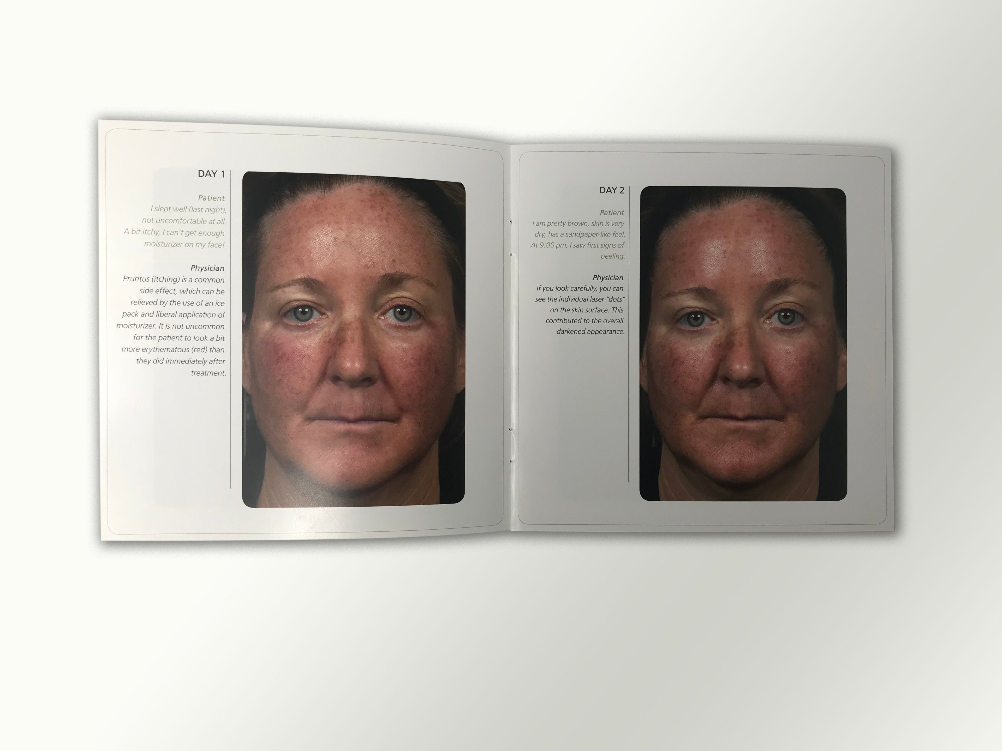 Fraxel Dual 1550 1927 Patient Diary Before & After Progress B&A Brochure Booklet