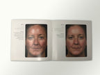 Fraxel Dual 1550 1927 Patient Diary Before & After Progress B&A Brochure Booklet