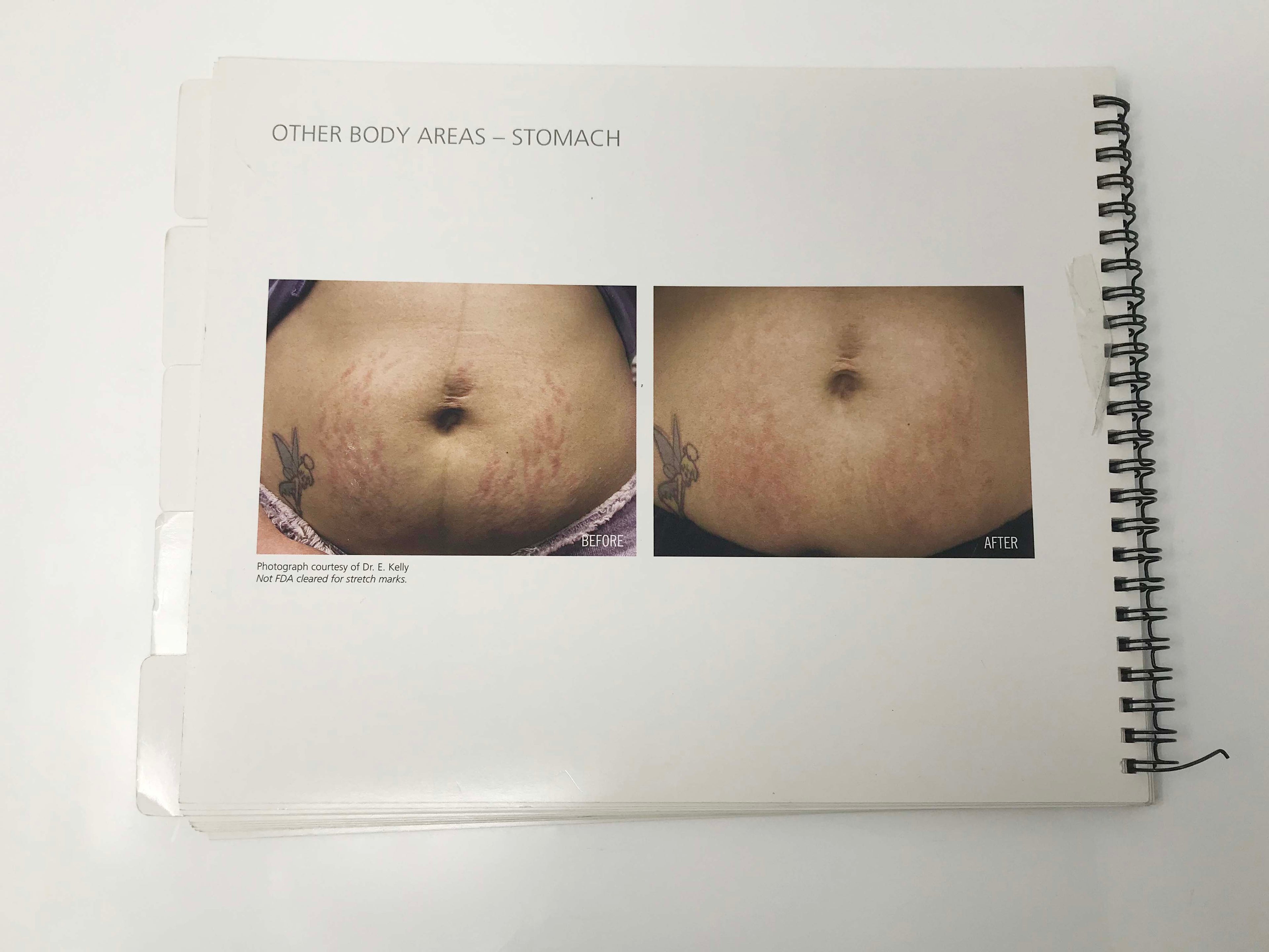 Fraxel Skin Rejuvenation Scar Removal Patient Results Treatment B&A Photo Book