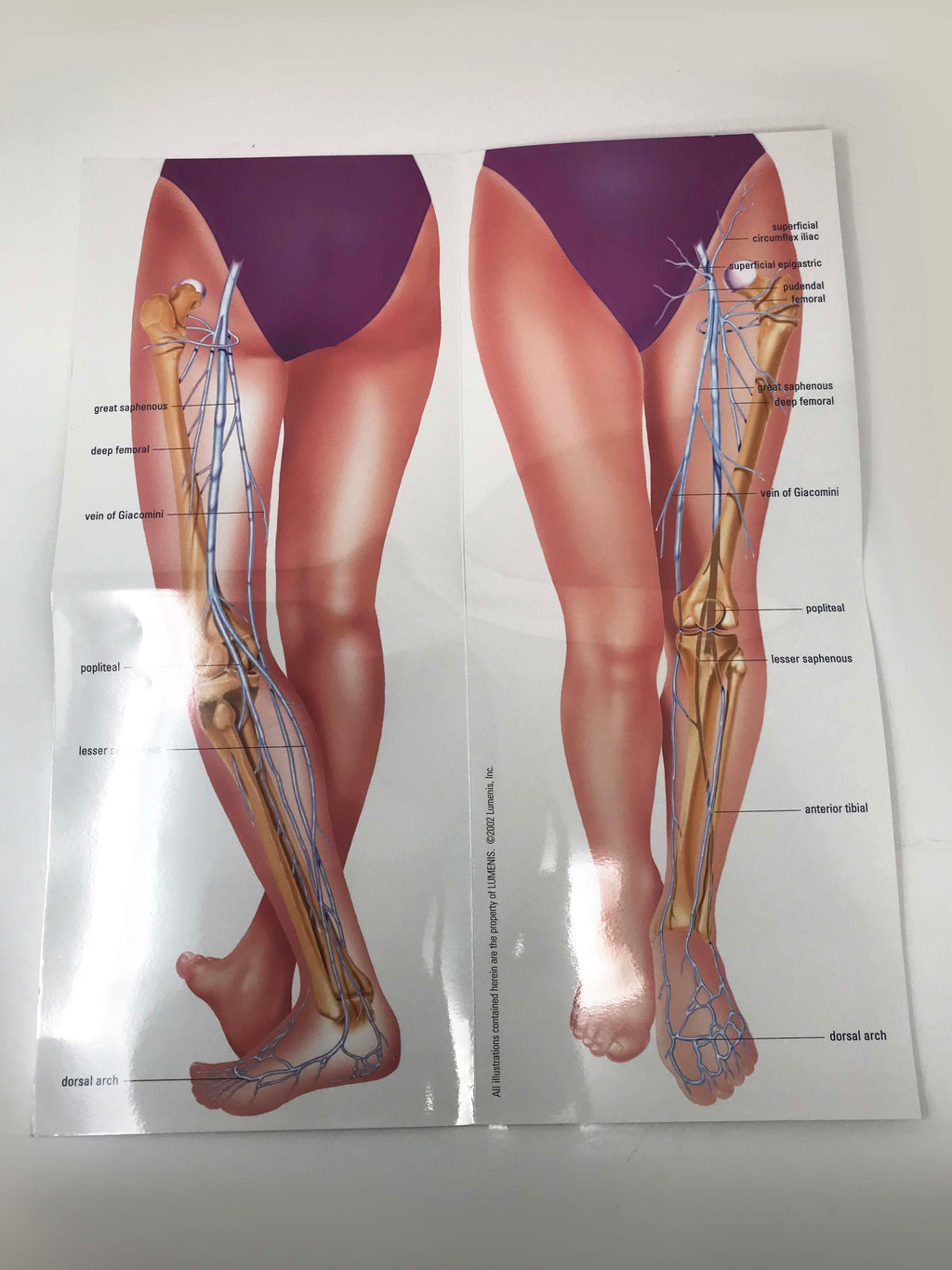 LUMENIS IPL laser Vascular 1064 Varicose Leg Vein Treatments Illustrative Poster