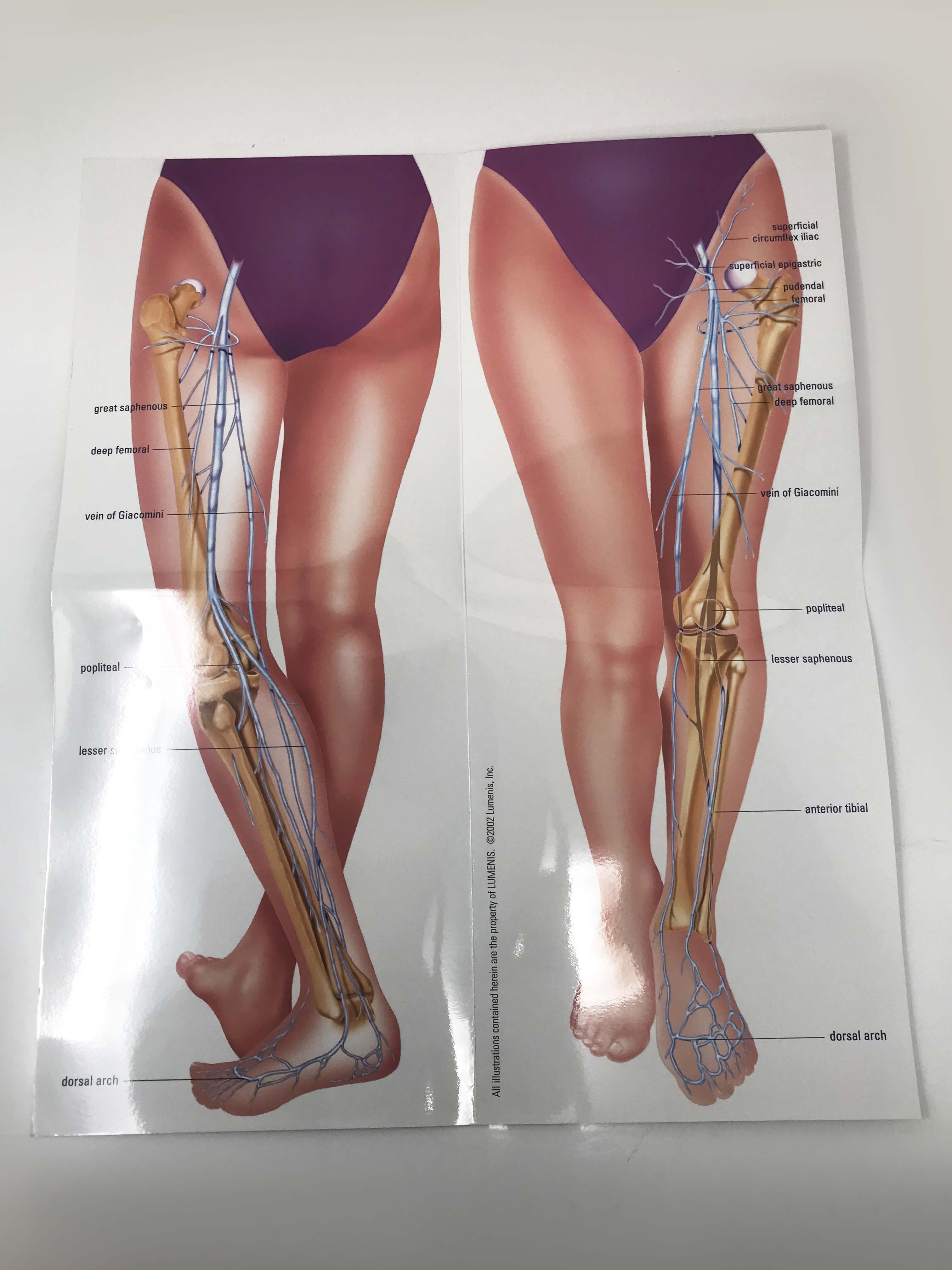 LUMENIS IPL laser Vascular 1064 Varicose Leg Vein Treatments Illustrative Poster