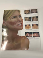 LUMENIS Quantum Laser IPL Aesthetic Skin Photo Rejuvenation Illustrative Poster